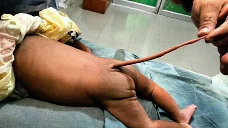 Bebê que nasceu com cauda de 13 centímetros é operado na Colômbia