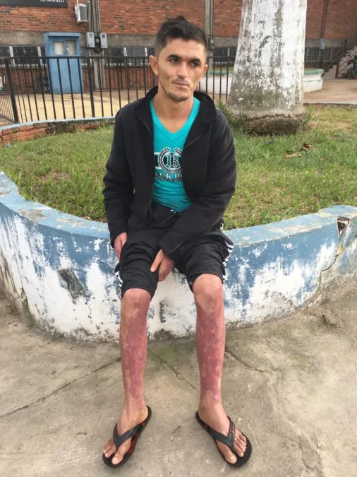 Sobrevivente de explosão de barco no AC fala de acidente: ‘só lembro que cai na água’