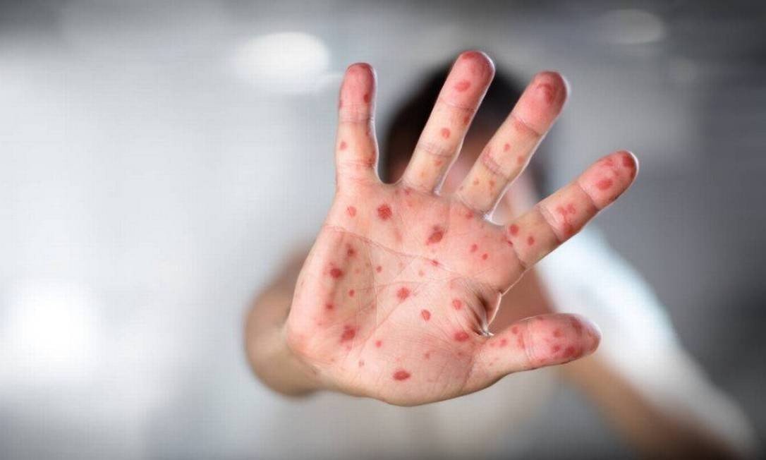 Na sombra da Covid-19, sarampo avança e provoca mortes no Brasil por falta de vacinação