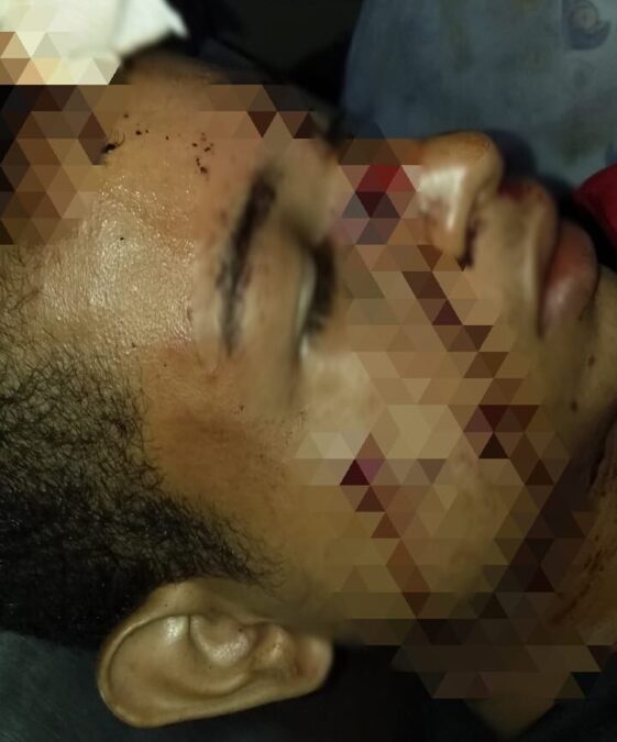 Após desentendimento, tio atira no rosto do próprio sobrinho em Sena Madureira