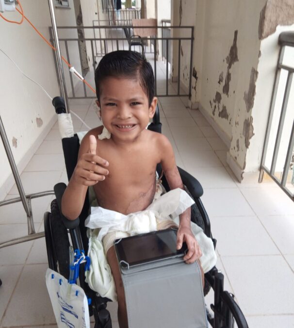 Após quase um mês, menino que caiu dentro de tacho de leite fervendo no Acre recebe alta da UTI
