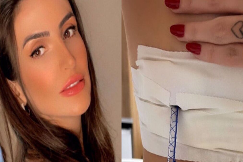 Empresária fica com pulmão perfurado após passar por sessão de acupuntura