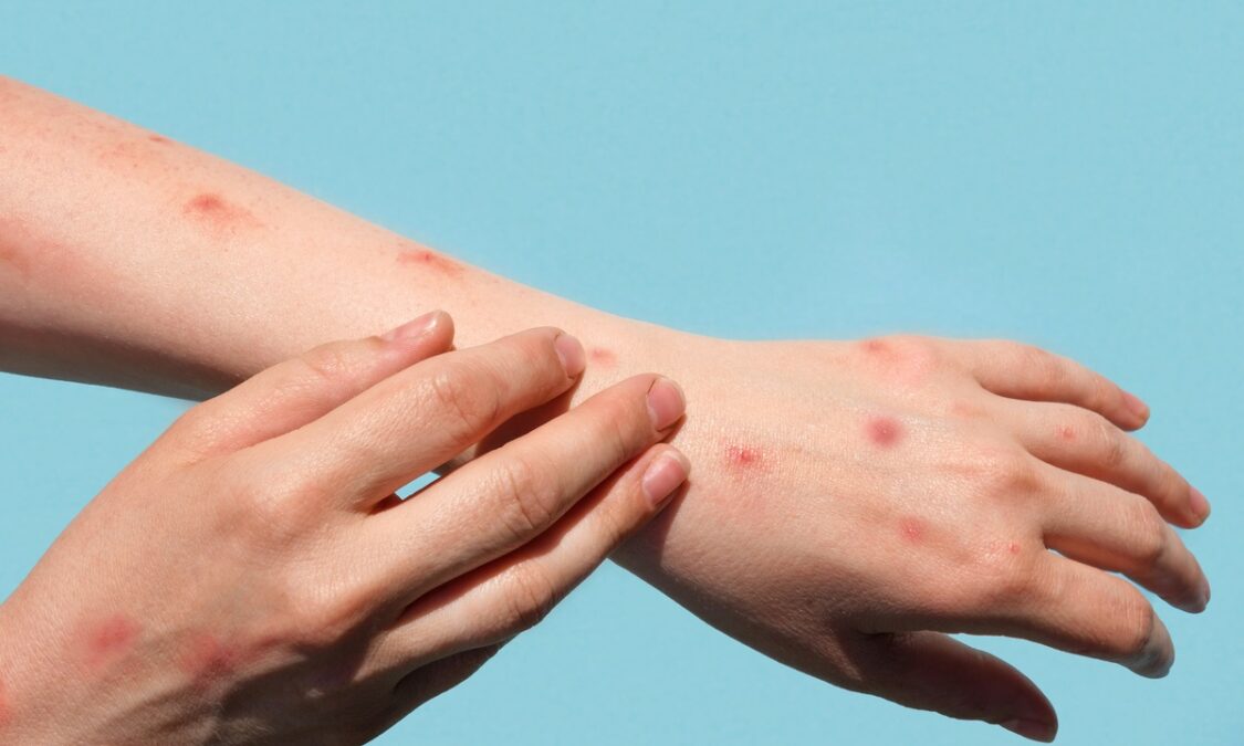 Saúde notifica caso suspeito de monkeypox no Acre