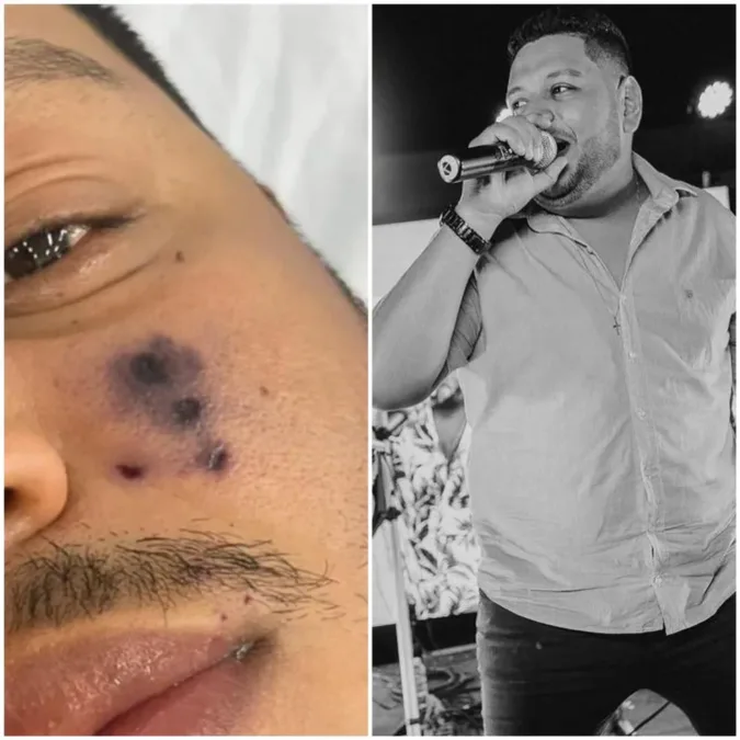 Cantor de forró morre após ser picado por aranha e rosto começar a escurecer, diz família