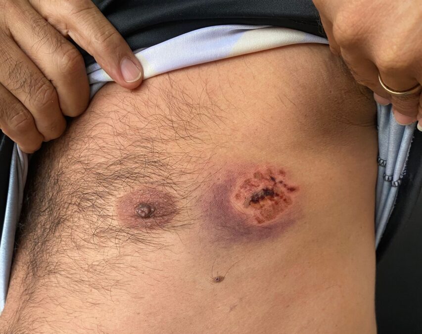 Técnico em Enfermagem mostra agressões feitas por monitorado em hospital de Sena Madureira