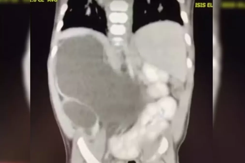 Menina rara com quatro rins desafia as estatísticas médicas