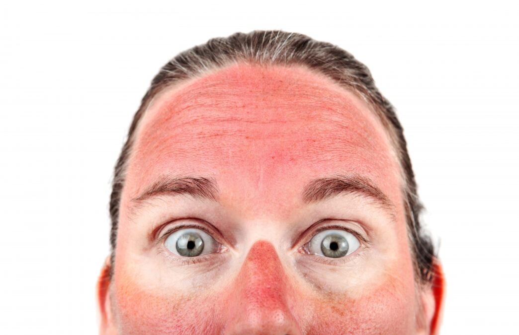 Onda de calor: riscos para a pele e estratégias de proteção durante o verão