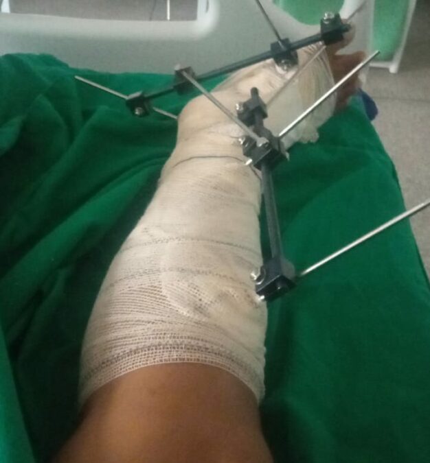 Empresária que sofreu acidente de moto em Sena Madureira, passará por duas cirurgias na perna