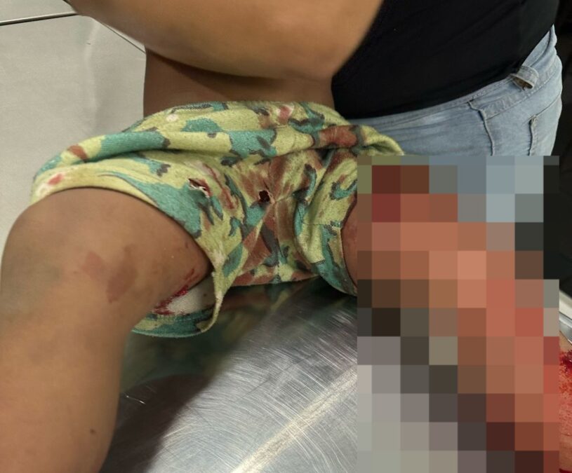 Menino de 7 anos é atacado por pitbull em Sena Madureira