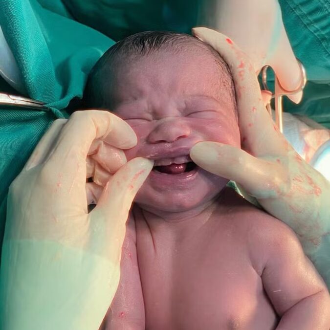 Bebê nasce com seis ‘dentes’ e surpreende equipe médica em MS