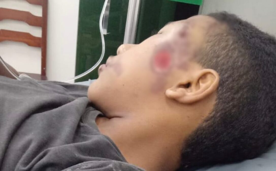 Família de adolescente atropelado em Sena Madureira pede ajuda para custear tratamento em Rio Branco