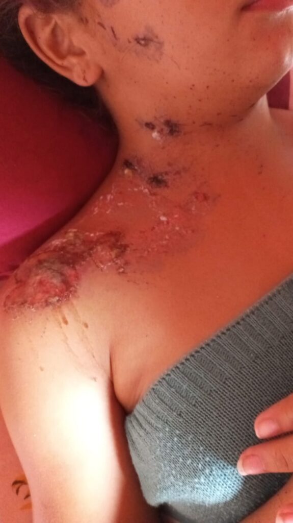 Aluna atingida por bomba em escola de Sena Madureira sofre queimaduras no rosto, pescoço e ombro