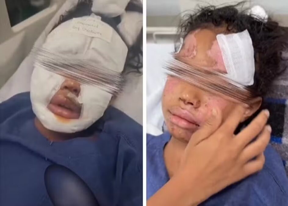 Nova tendência perigosa na internet: menino sofre queimadura grave ao explodir ovos no micro-ondas