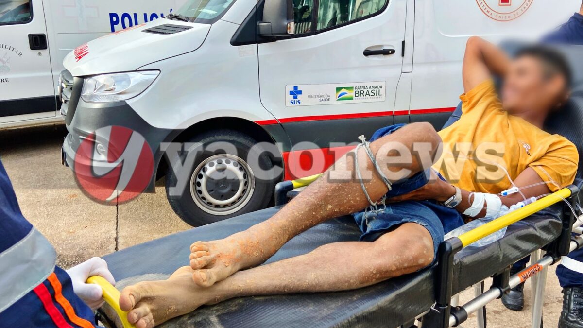 Jovem se arrasta por 1h30min no meio do mato após ser picado por cobra venenosa na zona rural de Rio Branco