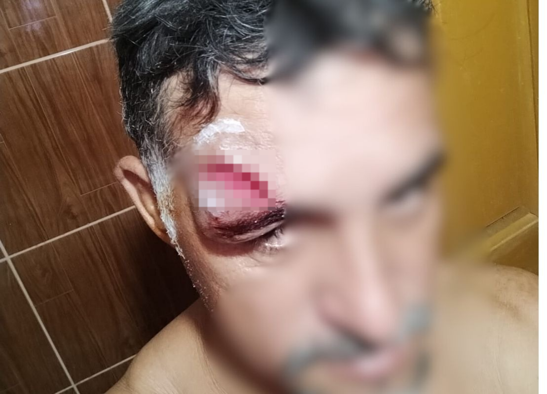 Homem sofre corte profundo no rosto após coice de burro em Sena Madureira