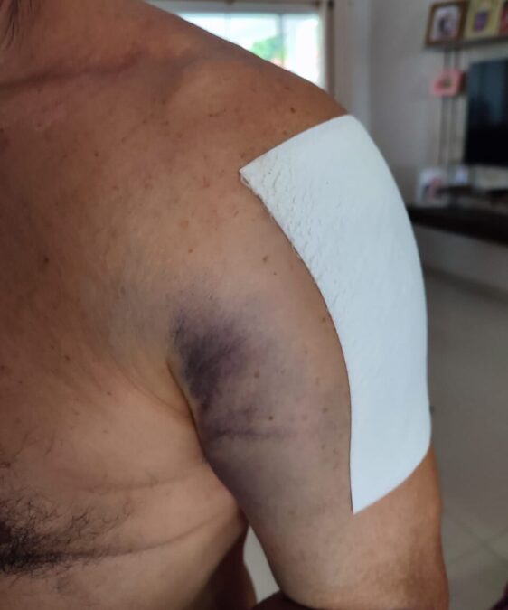 Funcionário público sofre acidente após ser atingido por adolescente empinando bicicleta em Sena Madureira