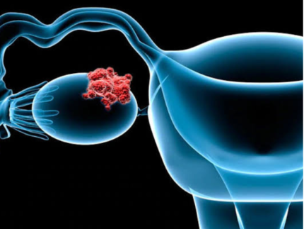 cancer-de-ovario:-estudo-revela-combinacao-de-medicamentos-promissora-no-tratamento