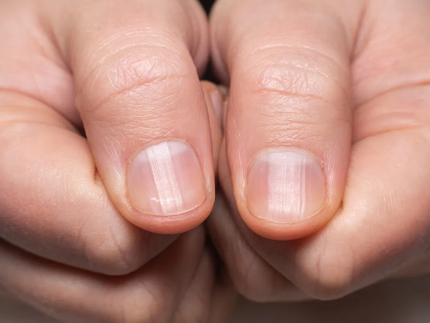 o-que-o-formato-da-meia-lua-da-unha-pode-revelar-sobre-a-saude?-medica-explica