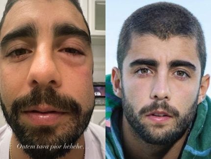 pedro-scooby-aparece-com-rosto-inchado-e-se-explica