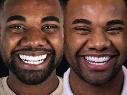 davi-brito-passa-por-transformacao-nos-dentes-apos-criticas.-veja-antes-e-depois!