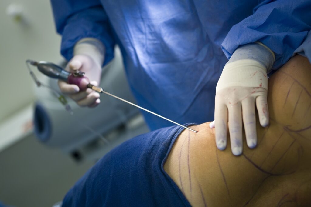 inverno-favorece-cirurgias-plasticas-e-acelera-recuperacao,-diz-expert