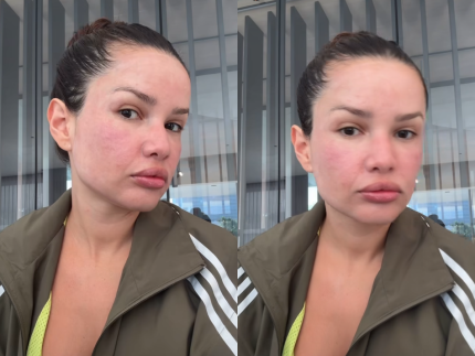 medico-de-juliette-explica-inchaco-apos-procedimentos-esteticos-no-rosto-da-cantora