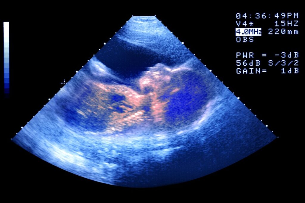 bebe-nasce-de-embriao-congelado-ha-30-anos-e-bate-recorde-mundial
