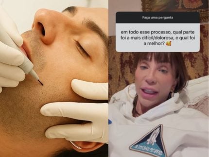 eletrolise:-saiba-o-que-e-o-tratamento-mais-complicado-da-transicao-de-maya-massafera