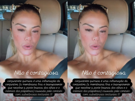 conjuntivite-quimica:-especialista-explica-doenca-diagnosticada-em-poliana-rocha