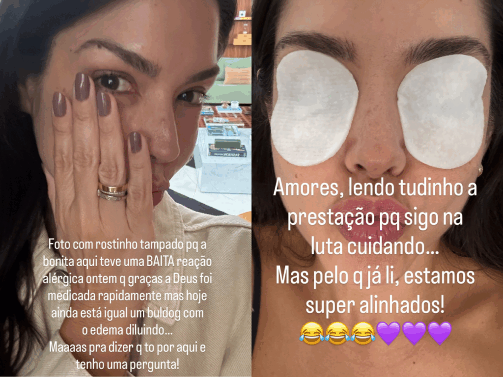 thais-fersoza-sofre-reacao-alergica-e-mostra-como-ficou-o-rosto:-“igual-um-buldogue”