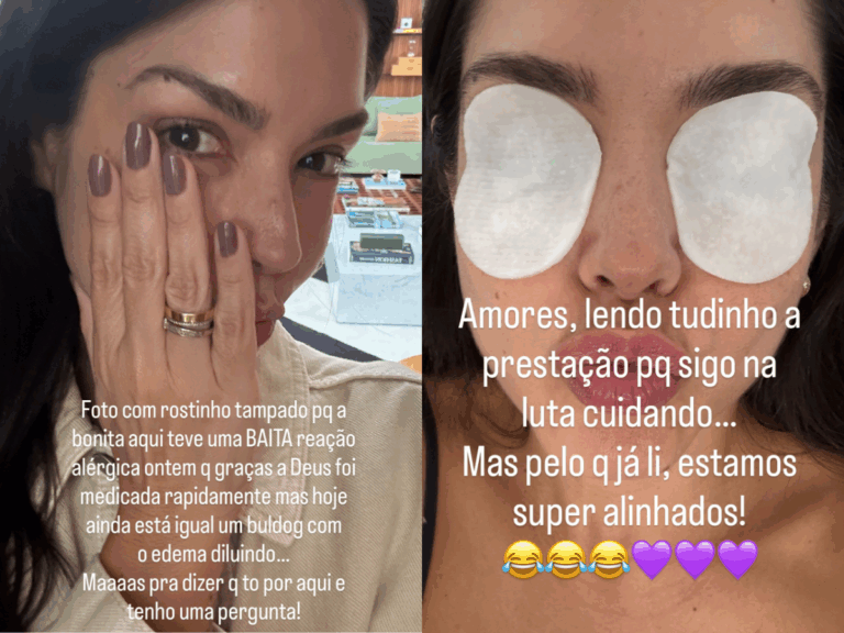 thais-fersoza-sofre-reacao-alergica-e-mostra-como-ficou-o-rosto:-“igual-um-buldogue”