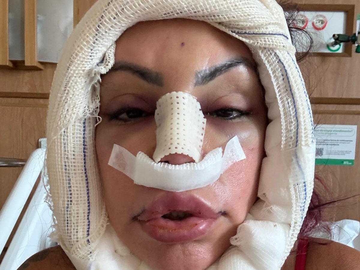 De cara nova! Liziane exibe resultado da cirurgia antecipada pelo portal LeoDias; confira
