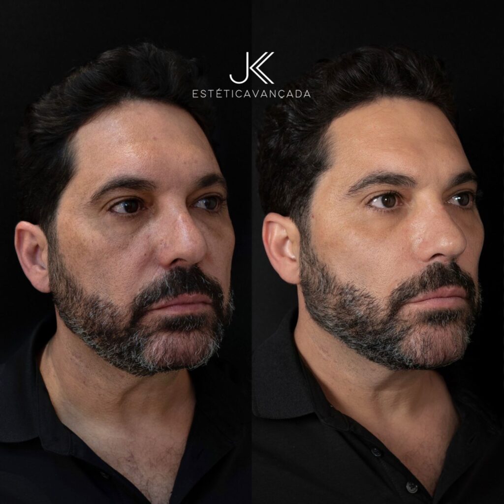 edson,-dupla-de-hudson,-passa-por-procedimento-estetico-de-rejuvenecimento.-saiba-o-valor!