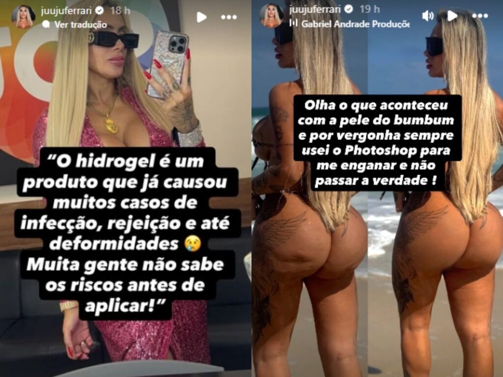 juju-ferrari-passa-por-cirurgia-de-emergencia-para-retirada-do-hidrogel-apos-infeccao