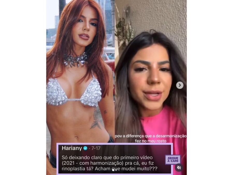 Hariany Almeida compara mudanças no rosto após harmonização e rinoplastia
