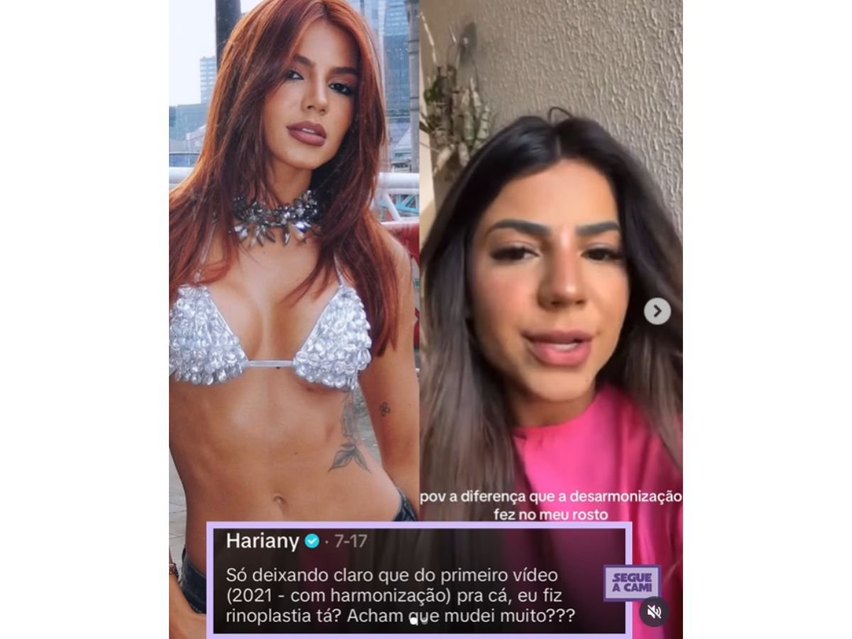 Hariany Almeida compara mudanças no rosto após harmonização e rinoplastia