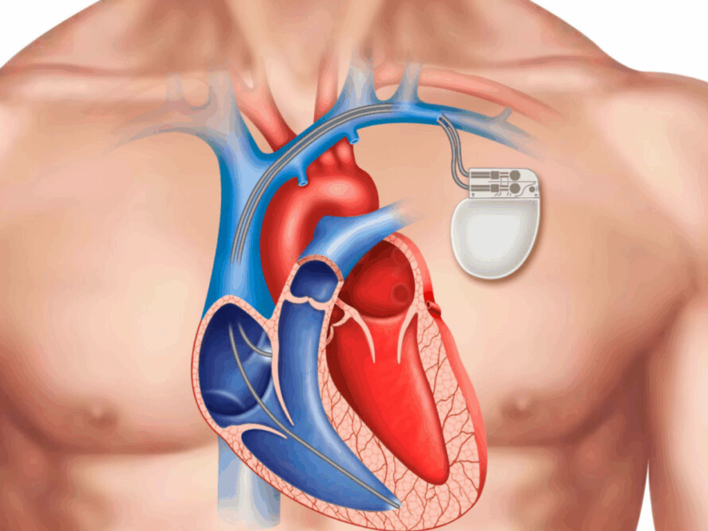 o-que-acontece-quando-seu-coracao-perde-o-ritmo?-entenda-a-funcao-do-marcapasso