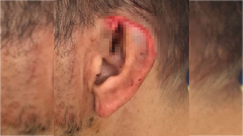 mike-tyson-do-cerrado:-homem-arranca-parte-da-orelha-de-namorado-no-df