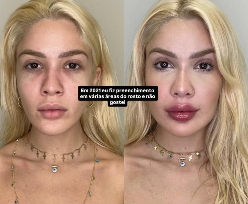 karoline-lima-relembra-erro-estetico-e-medica-alerta-para-riscos-do-excesso