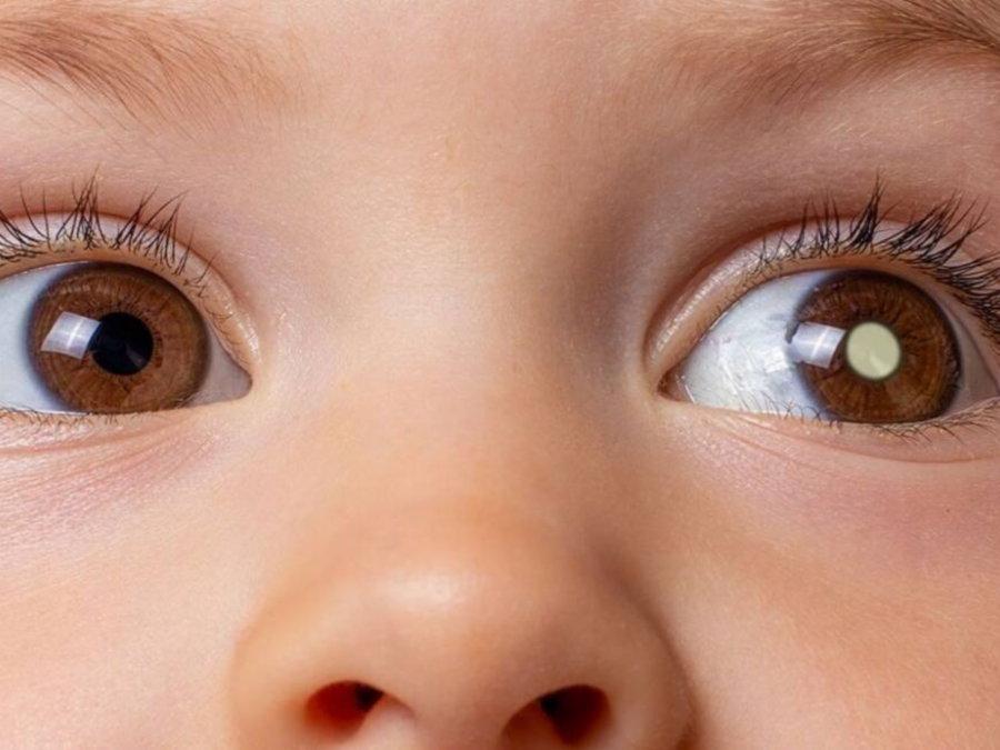 Retinoblastoma: especialista explica câncer nos olhos que acomete crianças