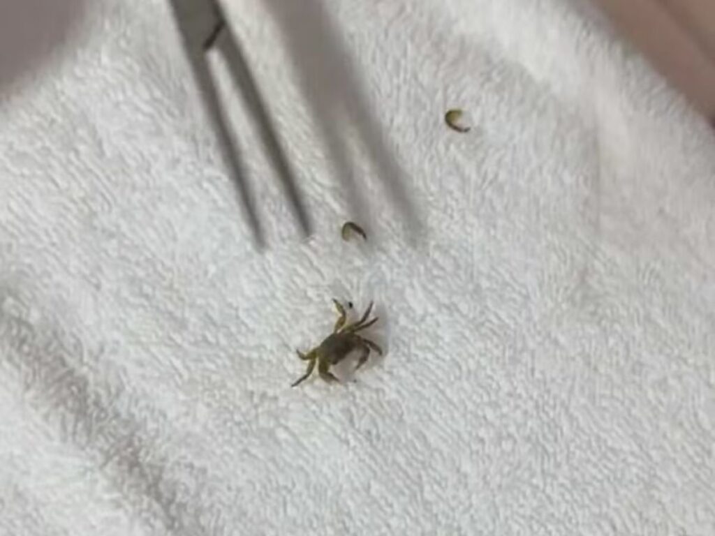 caranguejo-e-retirado-vivo-do-ouvido-de-um-menino-apos-dia-de-praia