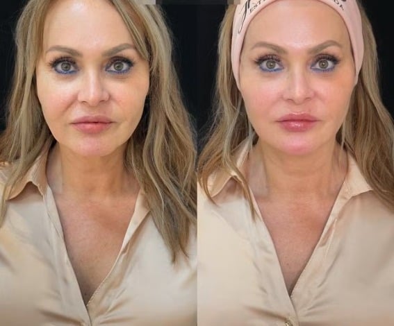 medico-comenta-exageros-e-principais-tendencias-esteticas-dos-peoes-em-“a-fazenda-17”