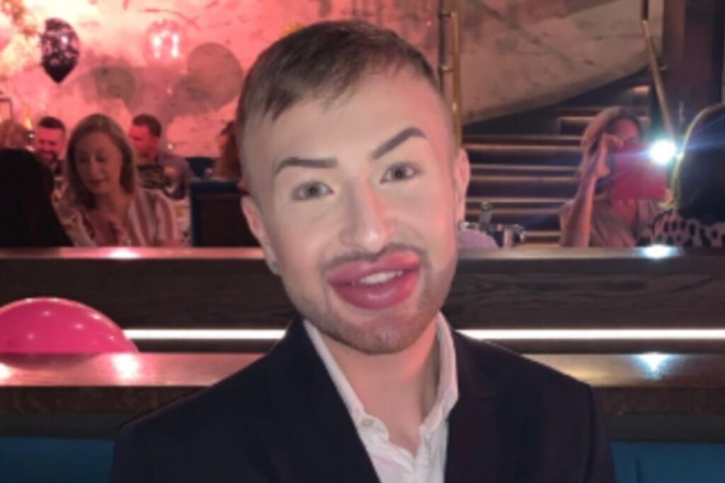 jovem-gasta-mais-de-r$-25-mil-com-preenchimentos-e-se-arrepende