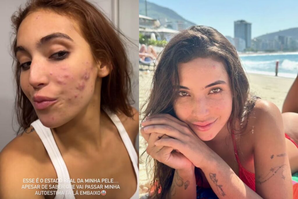 vanessa-lopes-diz-que-ficou-com-medo-de-perder-contratos-por-ter-acne