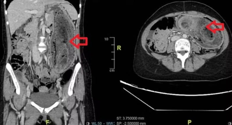 adolescente-e-operada-apos-medicos-encontrarem-bola-de-cabelo-gigante-no-estomago