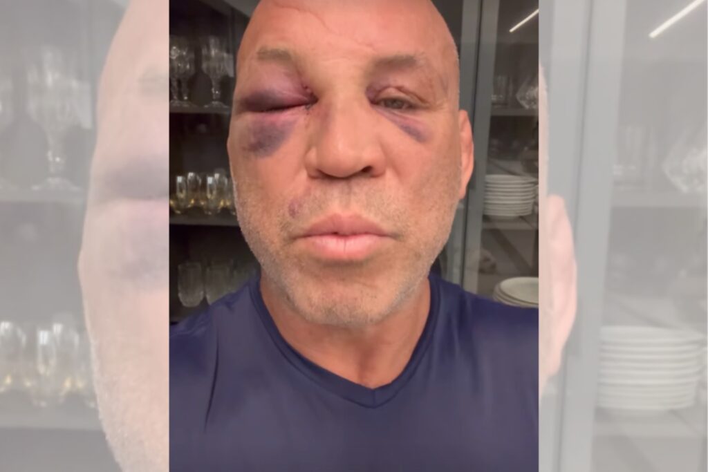 wanderlei-silva-detalha-recuperacao:-“memoria-esta-voltando”.-video