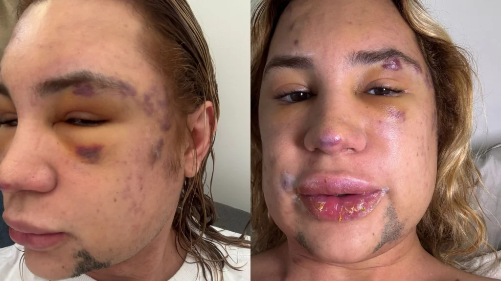 fox-eyes:-quais-sao-os-riscos-do-procedimento-que-influenciador-realizou