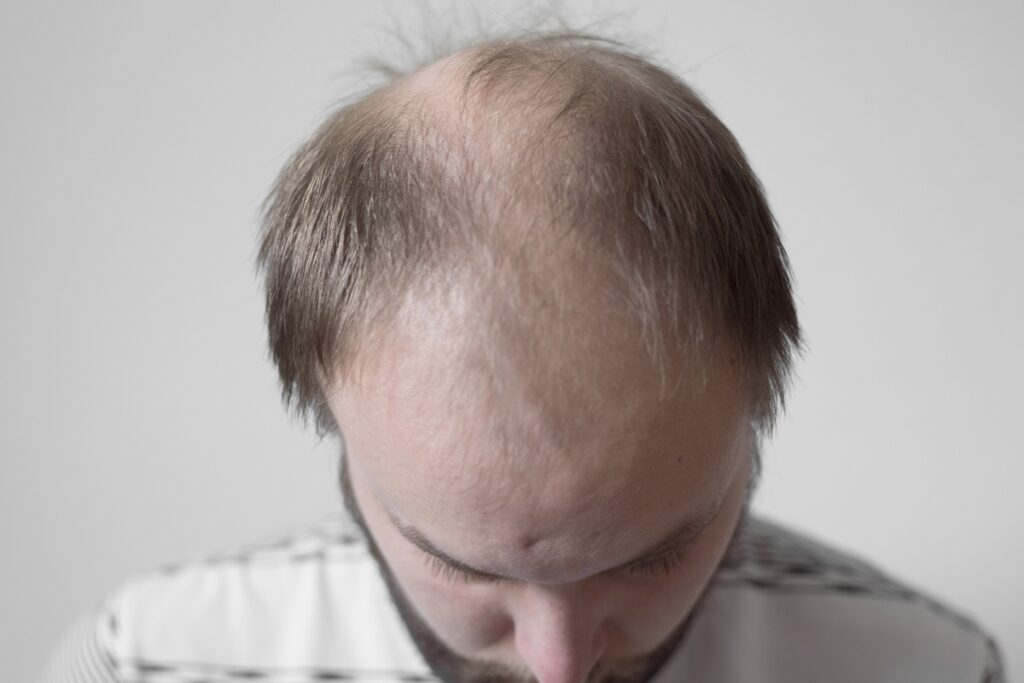 careca-doce:-composto-de-estevia-faz-crescer-67%-mais-cabelo-em-calvos