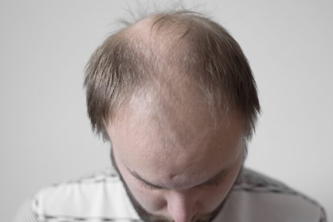 careca-doce:-composto-de-estevia-faz-crescer-67%-mais-cabelo-em-calvos