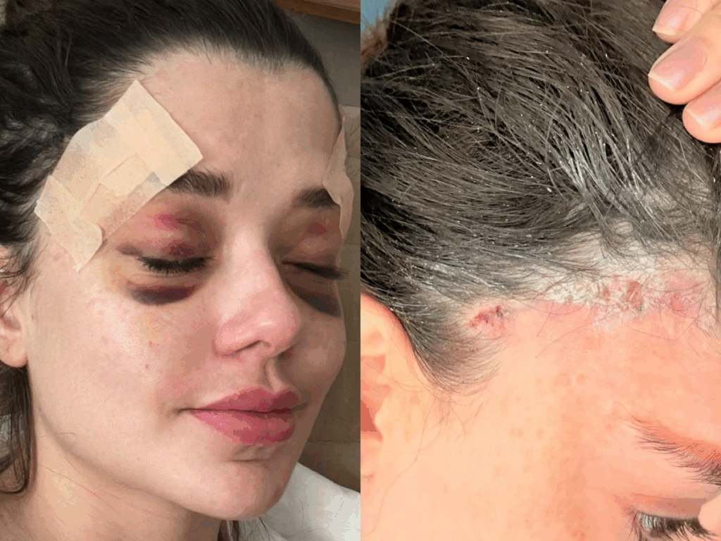 modelo-apresenta-mesmos-sintomas-de-influenciador-que-morreu-e-registra-b.o-contra-dentista